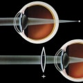 Understanding Hyperopia (Farsightedness)